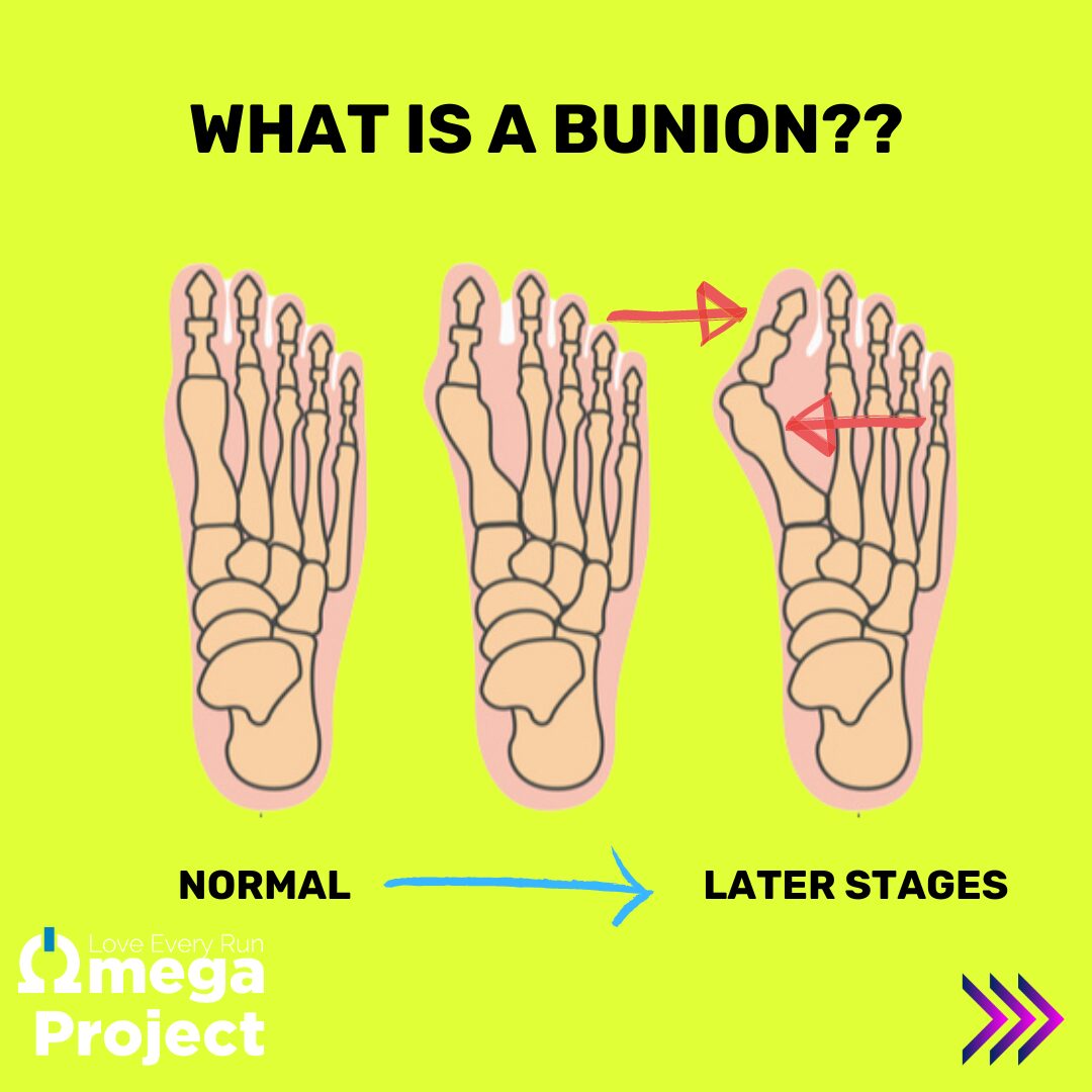 What is a Bunion?