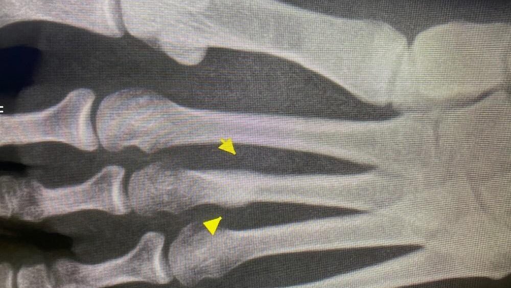 Stress Fractures